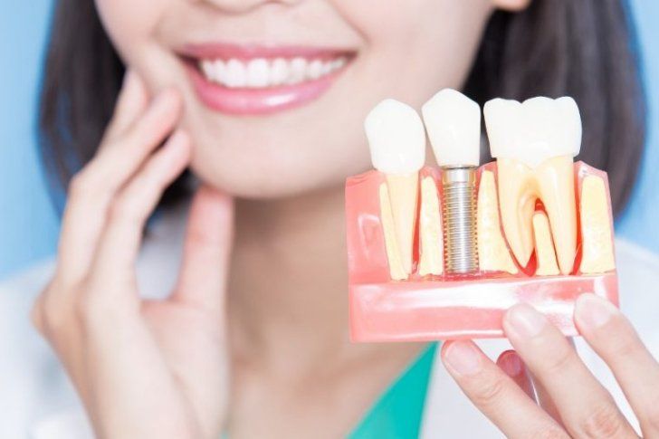 🦷 Implants Dentaires : Une solution durable pour remplacer vos dents